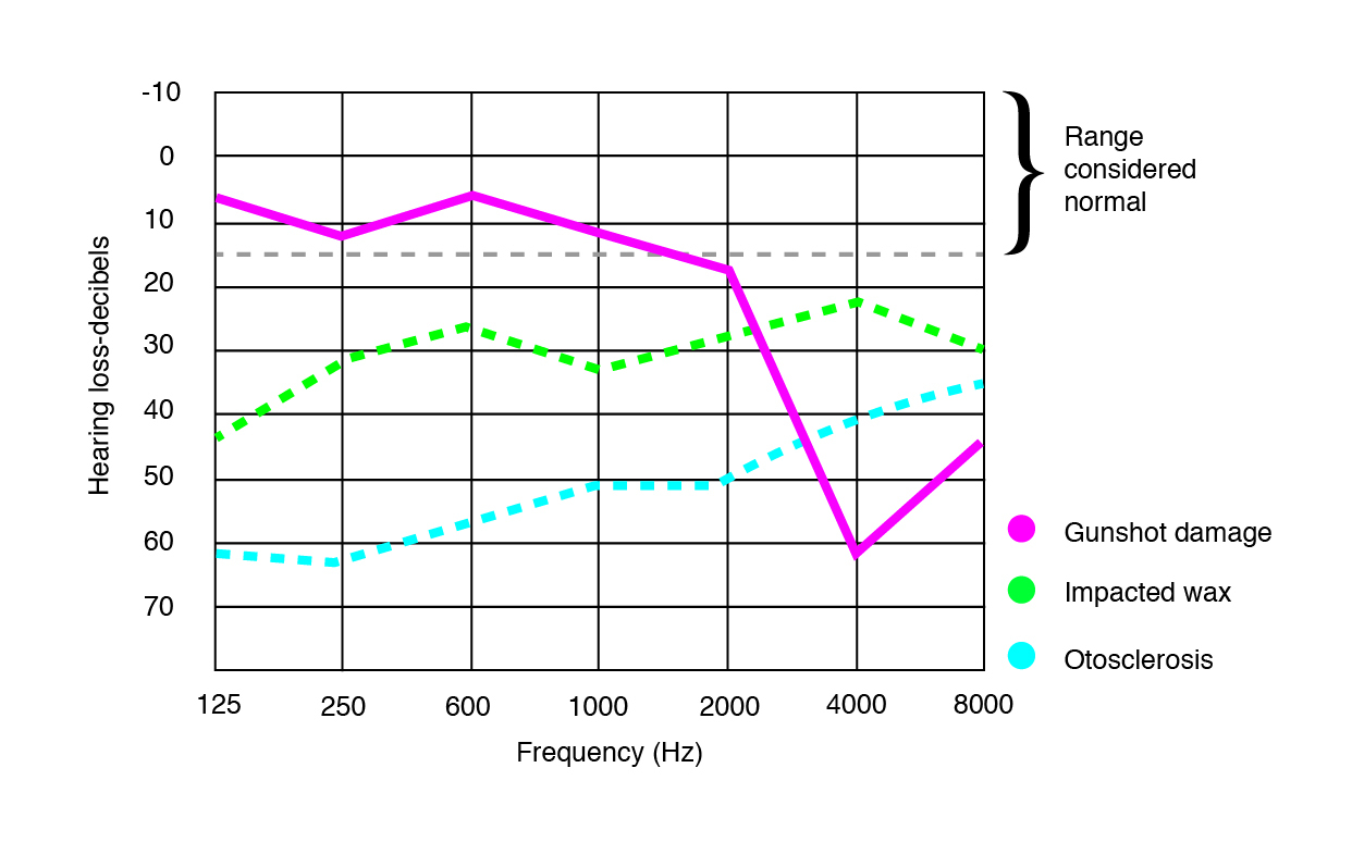 Audiogram comparison between different hearing impairments.