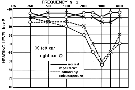Audiogram comparison: Normal hearing impairment due to Loud Noise