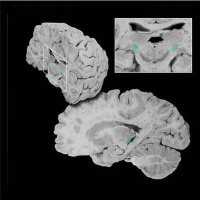 Medial Geniculus Nucleus